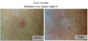 Tratarea cu laser a varicelor în Togliatti