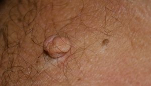 Papiloame în zona inghinală. HPV (Human Papilloma Virus) | ARAS – Asociatia Romana Anti-SIDA