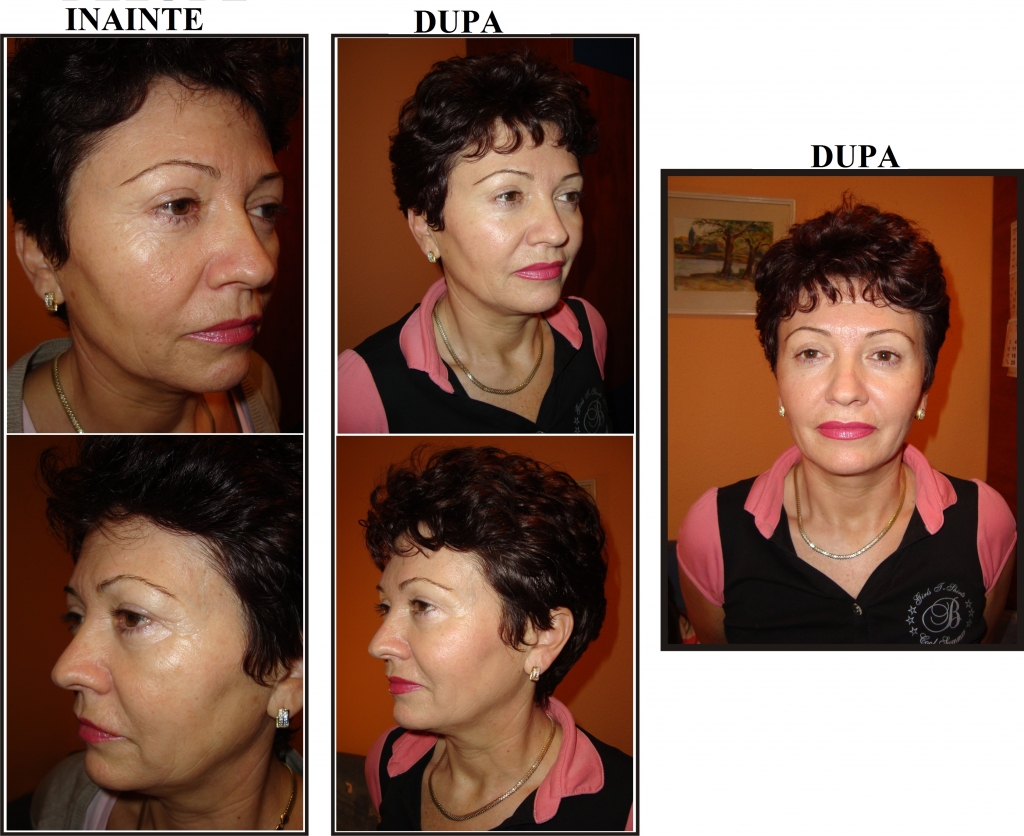 efectele botoxului pe termen lung)