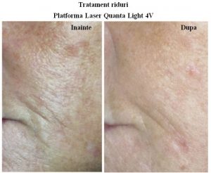 crema de recuperare a pielii sistemul ridurilor scualenă în produsele cosmetice pentru față împotriva ridurilor